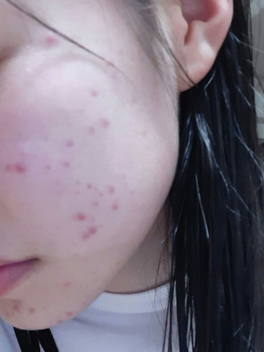 ビーソフテン ローション(医薬品)/持田製薬/その他を使ったクチコミ（1枚目）