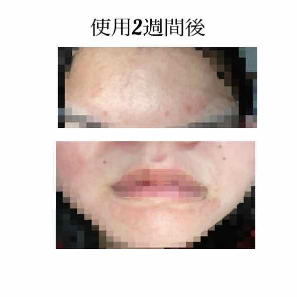 幸子 on LIPS 「皮膚科で貰ったエピデュオゲルを使用して1ヶ月後が経ったので、レ..」(3枚目)