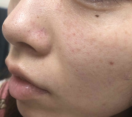 ネイチャーコンク 薬用クリアローション/ネイチャーコンク/拭き取り化粧水を使ったクチコミ(2枚目)