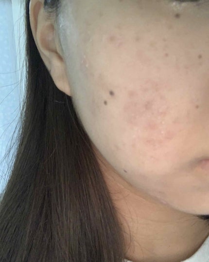 ニキビ治療薬クリーム (医薬品)/クレアラシル/その他を使ったクチコミ(3枚目)