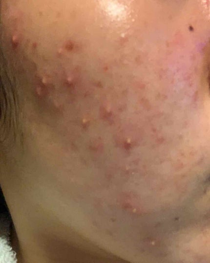 ひよこ on LIPS 「相談です。右頬と左頬の肌荒れの具合が違うのは何故なんでしょうか..」(2枚目)