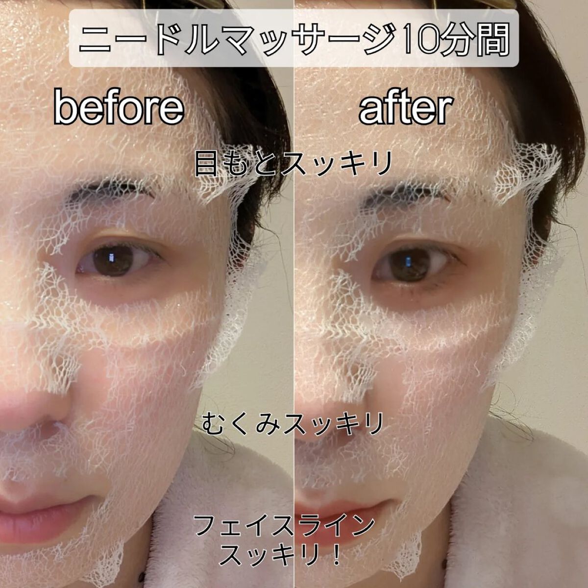 リンクルフィットマスク+ニードルローラー/MEDITHERAPY/美顔器・マッサージを使ったクチコミ（2枚目）