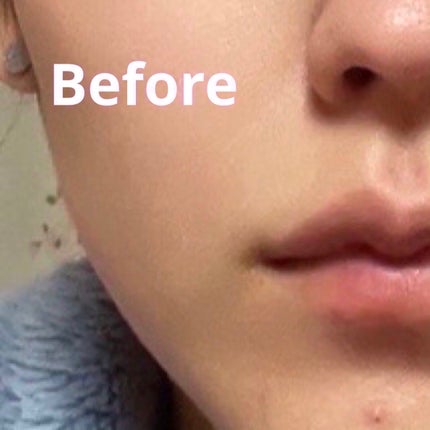 薬用スポットシーラークリーム/スキンヒーロー/クリームコンシーラーを使ったクチコミ(2枚目)