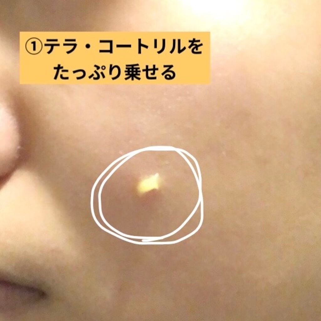 からしちゃん on LIPS 「どうもっからしです。今回は、厄介な赤ニキビ・黄ニキビをたった数..」(2枚目)
