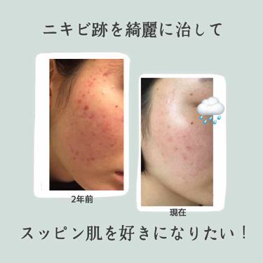 22年最新 ニキビケア 高校生特集 口コミで人気の37アイテムを紹介 Lips 22年最新 ニキビケア 高校生特集 口コミで人気の37アイテムを紹介 Lips