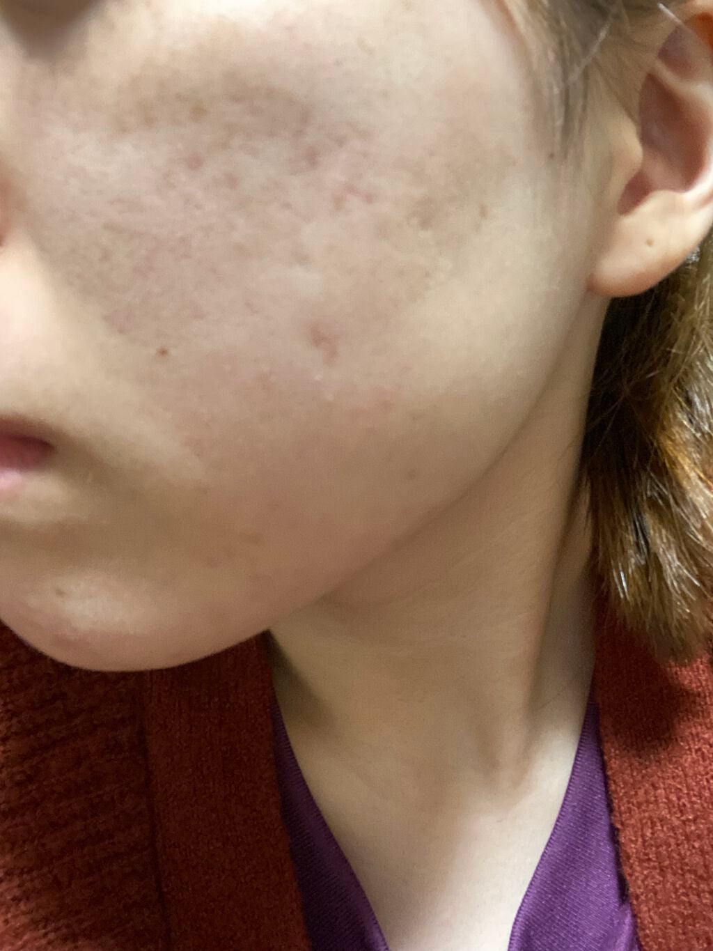 薬用アクネホワイトニング ジェル(部分用美容液)/DHC/美容液を使ったクチコミ(4枚目)