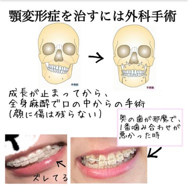 ぽむ on LIPS 「歯列矯正についてお話します！！私は一昨年の10月から歯列矯正を..」（5枚目）