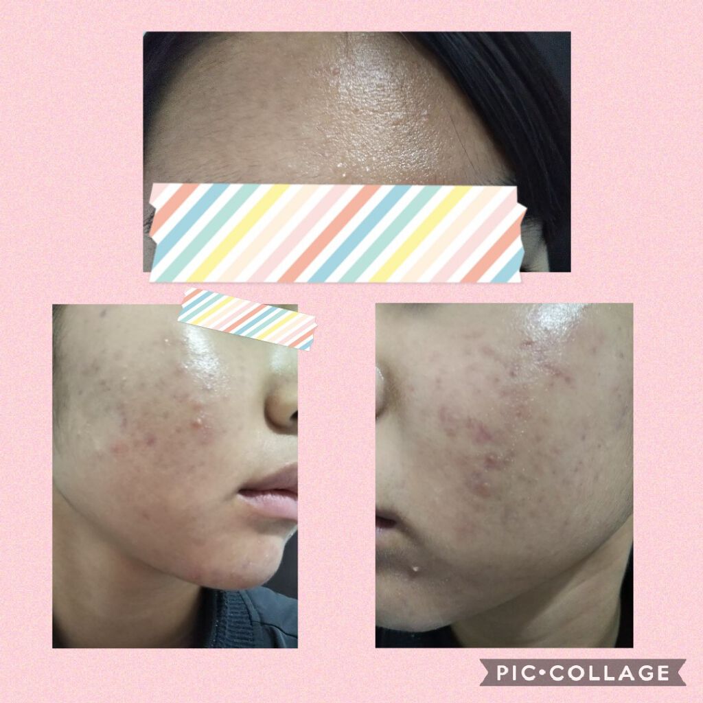 A アクネローション/NOV/化粧水を使ったクチコミ（3枚目）