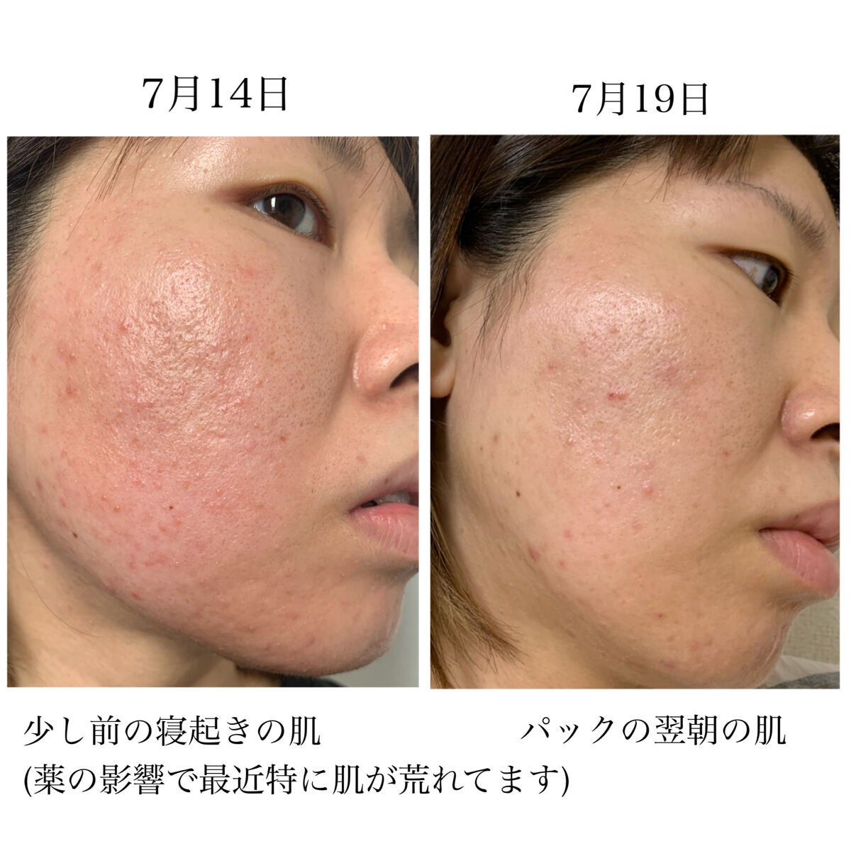 リアルカレンデュラ ディープエッセンスマスク/APRILSKIN/シートマスク・パックを使ったクチコミ(7枚目)