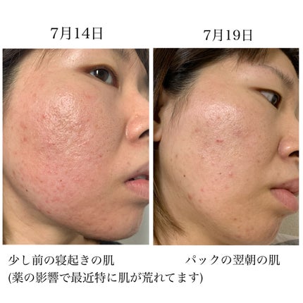 リアルカレンデュラ ディープエッセンスマスク/APRILSKIN/シートマスク・パックを使ったクチコミ(7枚目)