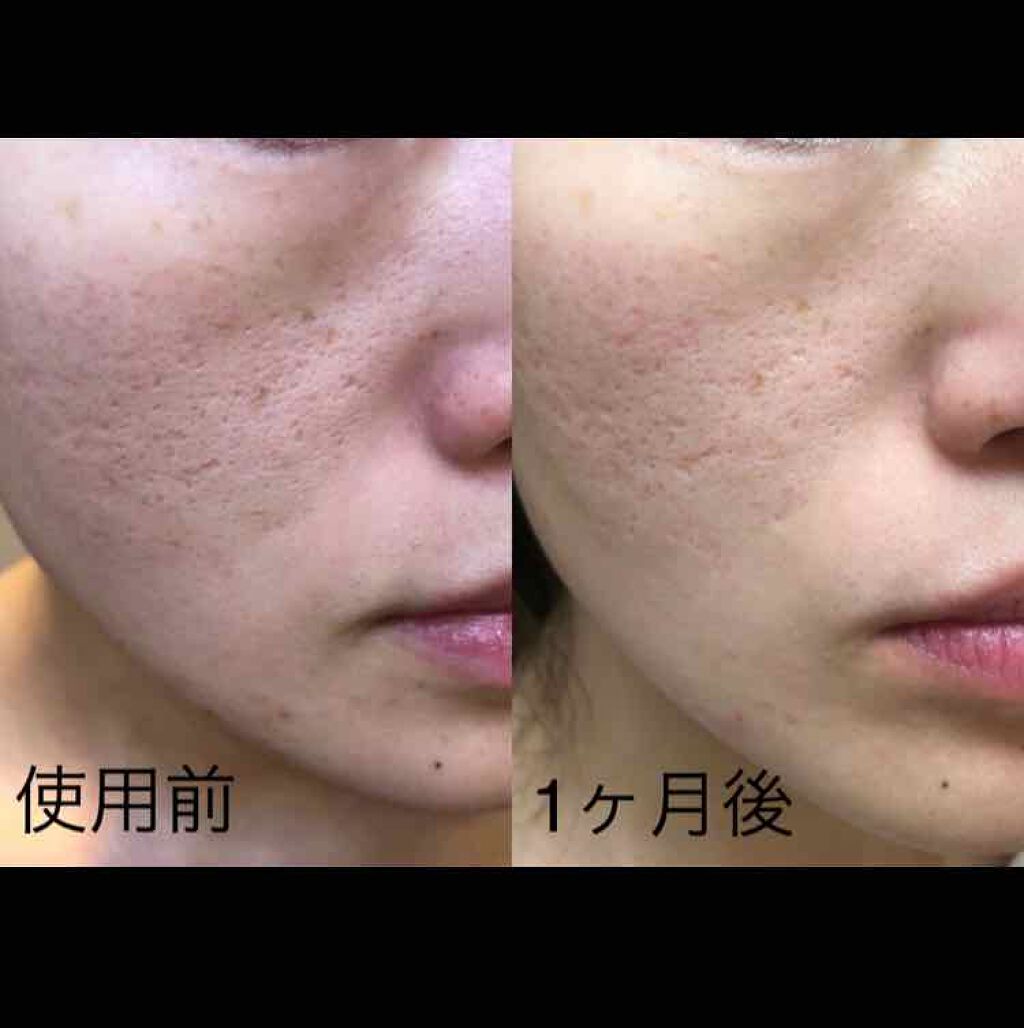 薬用ベビーパウダー/ピジョン/ボディパウダーを使ったクチコミ(3枚目)