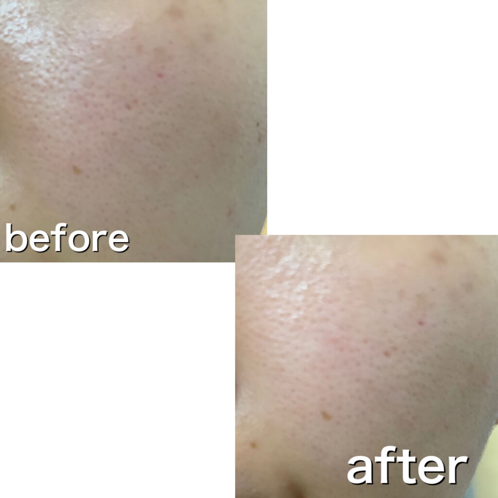 ヘルプミー! ポア-Tパッド/One-day's you/トナーパッドを使ったクチコミ（3枚目）