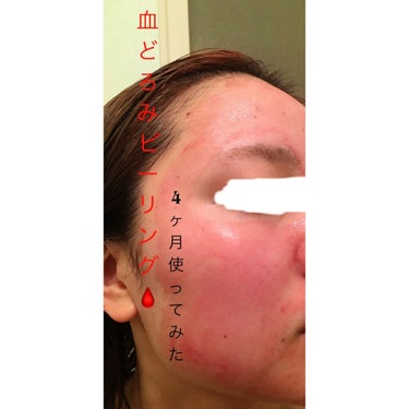 AHA 30% + BHA 2% Peeling Solution/The Ordinary/ピーリングを使ったクチコミ（1枚目）