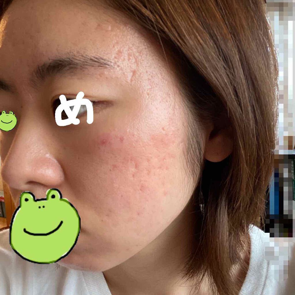 極潤 ヒアルロン乳液 旧 肌ラボを使った口コミ かばおですこんにちは 肌断食やめてみました By かばお 混合肌 代前半 Lips