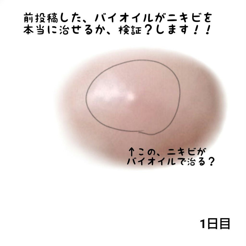 バイオイル/バイオイル/フェイスオイルを使ったクチコミ(1枚目)