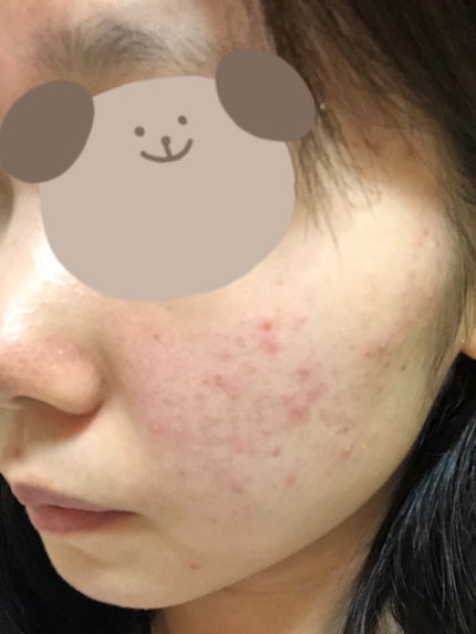 オードムーゲ 薬用ローション(ふきとり化粧水)/オードムーゲ/拭き取り化粧水を使ったクチコミ(4枚目)