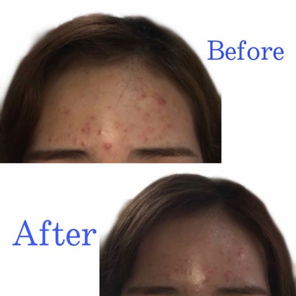 ペアアクネクリームW(医薬品)/ペア/その他を使ったクチコミ(2枚目)