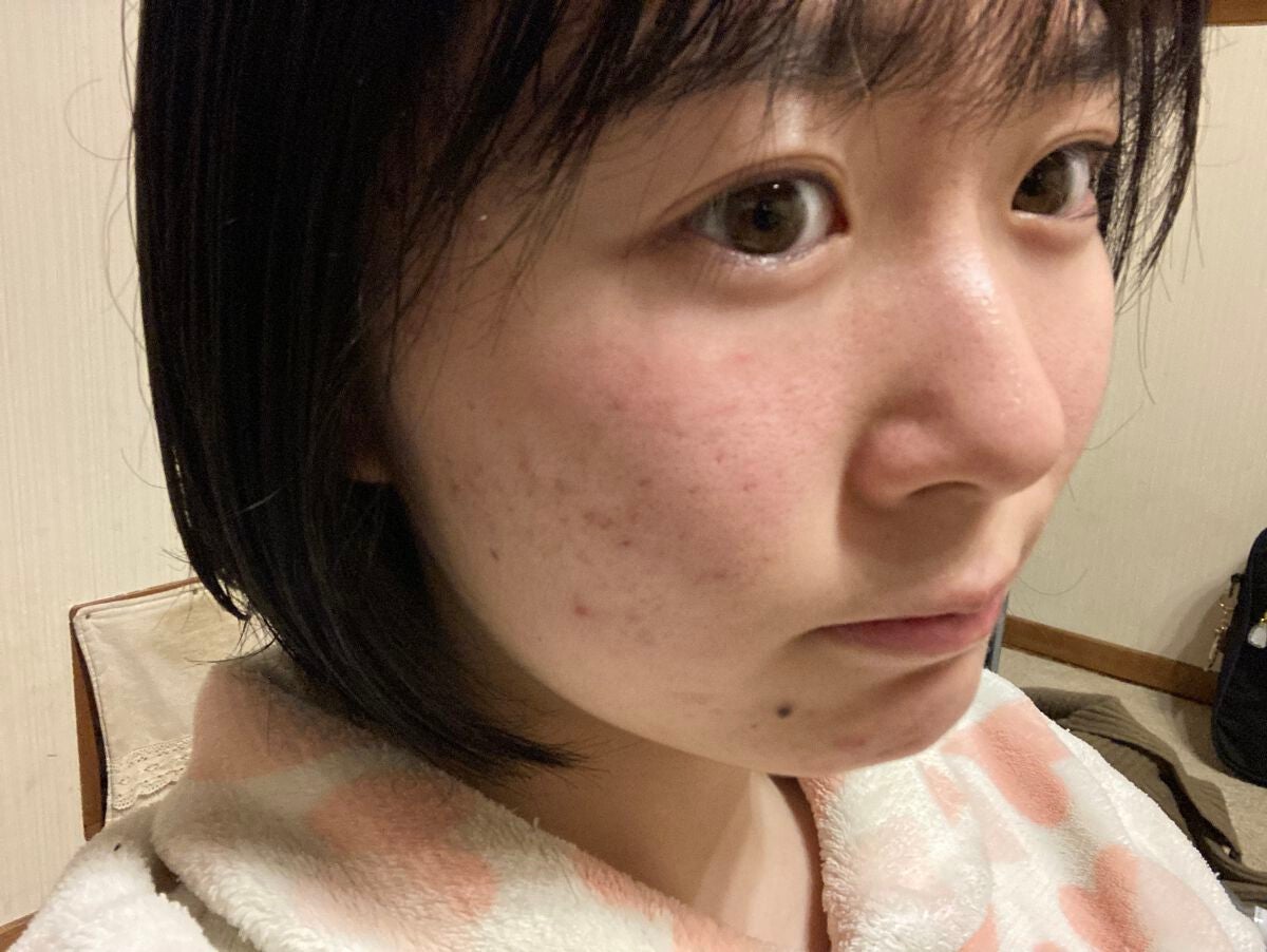 星影スズカ on LIPS 「【高校生ニキビ奮闘日記23日目】結構綺麗になってきたかも?早く..」(1枚目)