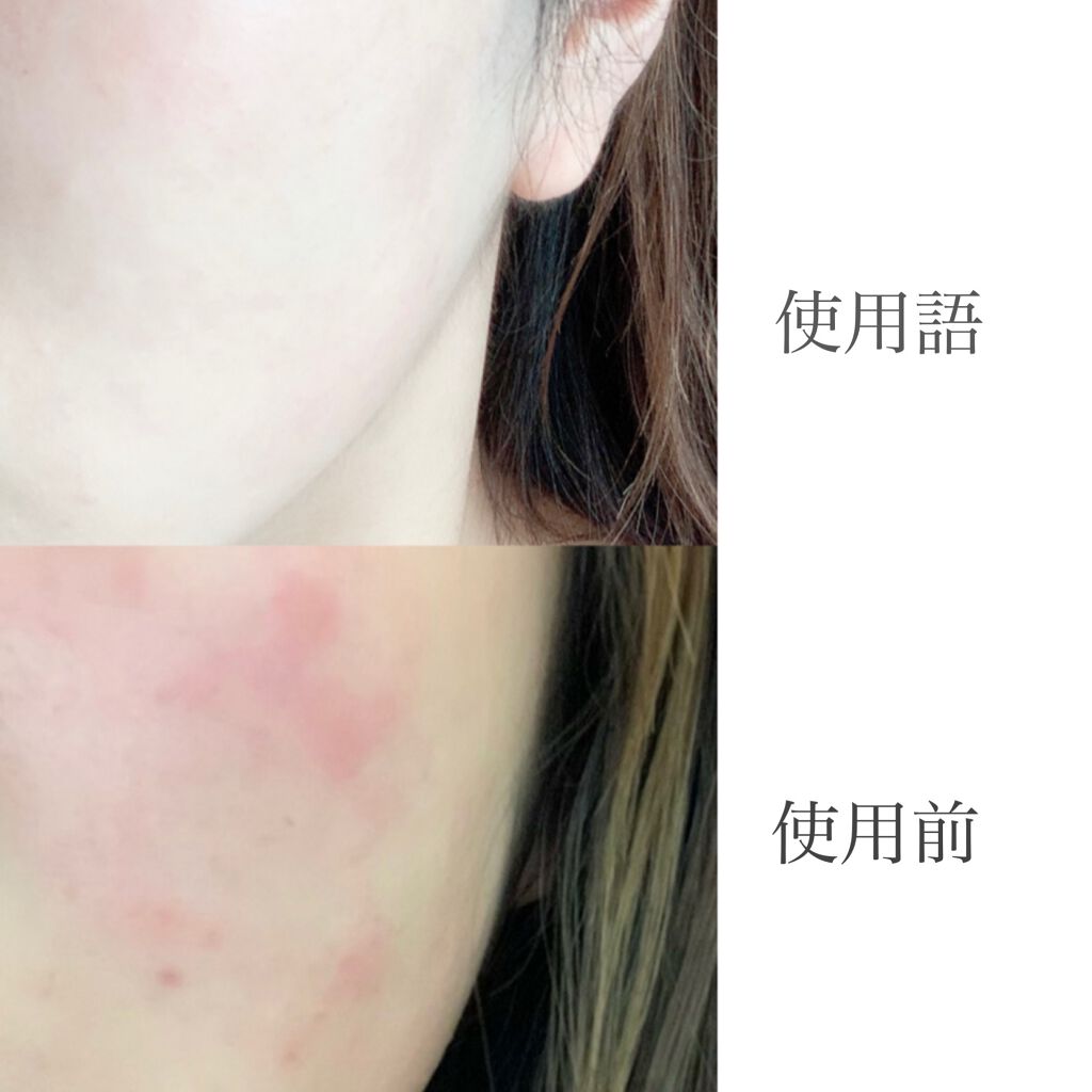 パーフェクトホイップ アクネケア/SENKA（専科）/洗顔フォームを使ったクチコミ（3枚目）