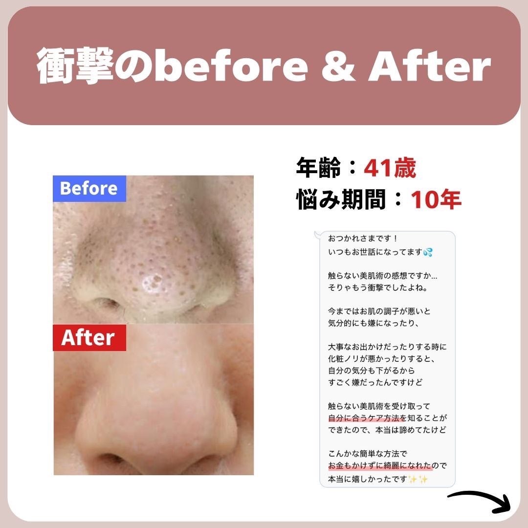 あなたの肌に合ったスキンケア💐コーくん先生 on LIPS 「【9割が知らない】鼻の黒ずみがゴッソリ消える裏技🤫..あなたの..」(3枚目)