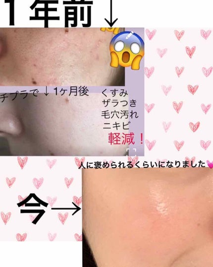 ミノン アミノモイスト 薬用アクネケア ローション/ミノン/化粧水を使ったクチコミ(1枚目)