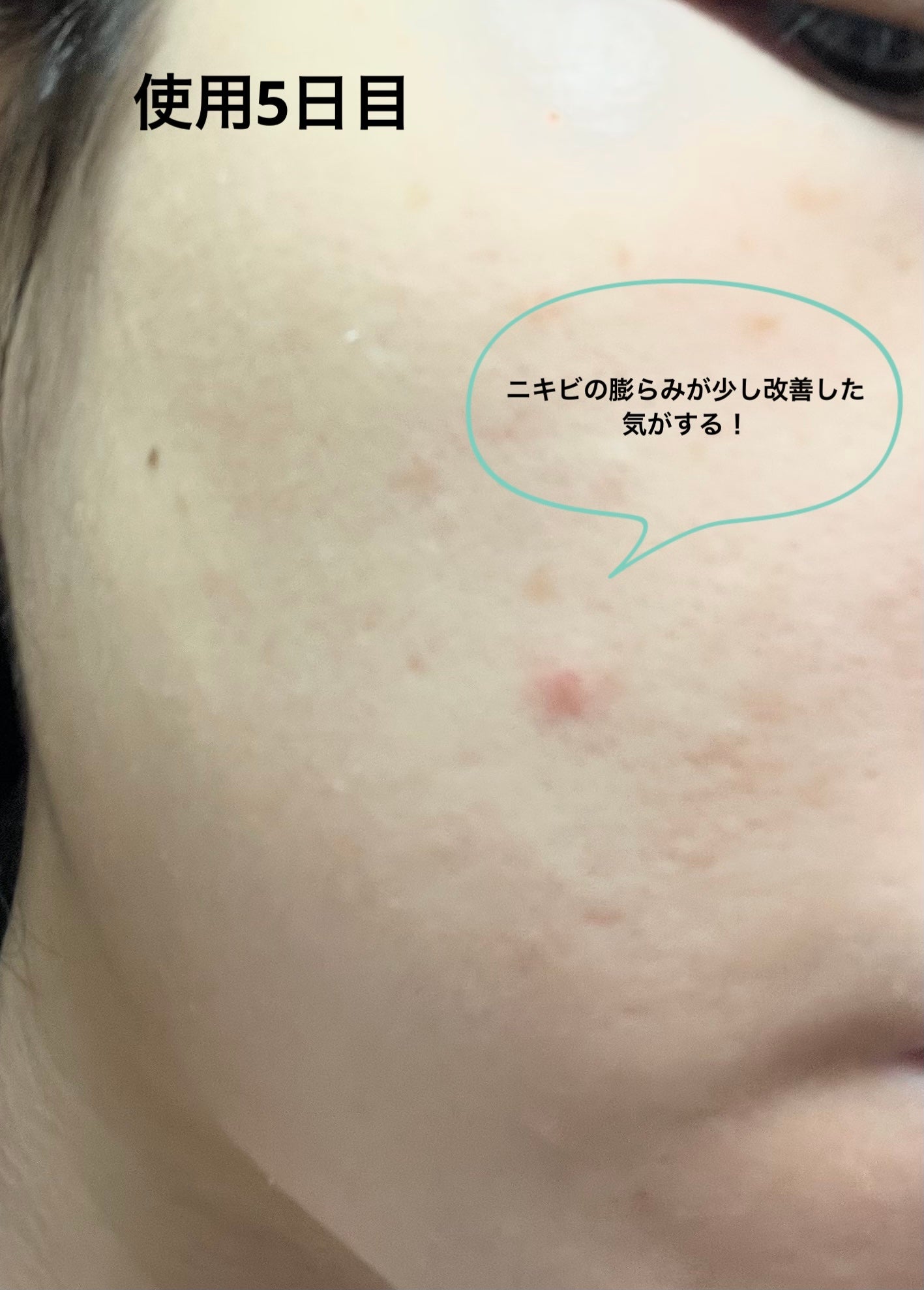 RXザ・アルファアルブチン2 ニキビ跡ケアセラム/COSRX/美容液を使ったクチコミ(4枚目)