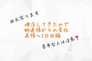 【埋没法直前からダウンタイム2日目まで編】
聞きたいこと、気になることあれば質問どうぞ！


久しぶりの投稿ですが、実は私…

埋没してきました！！！

元々奥2重でアイプチの癖付けにより二重にはなって