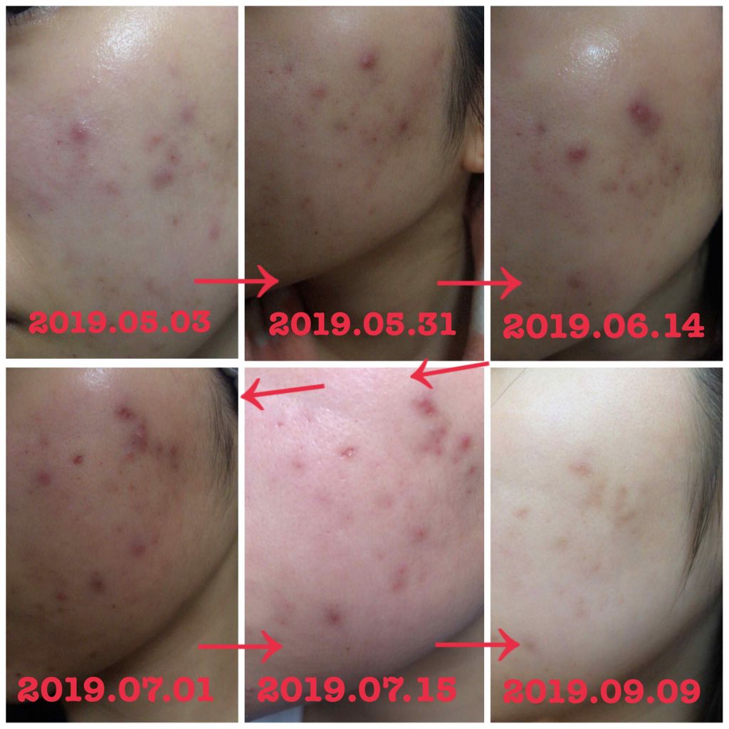 十味敗毒湯 ジュウミハイドクトウ(医薬品)/クラシエ薬品/その他を使ったクチコミ(3枚目)