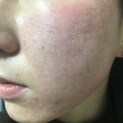 ティーツリーケア ソリューション エッセンシャルマスクEX/MEDIHEAL/シートマスク・パックを使ったクチコミ(3枚目)