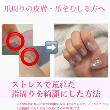 𝐒𝐮𝐢 on LIPS 「【ストレスでボロボロ、出血しがちな指周りを直した方法】🌟経緯小..」（1枚目）