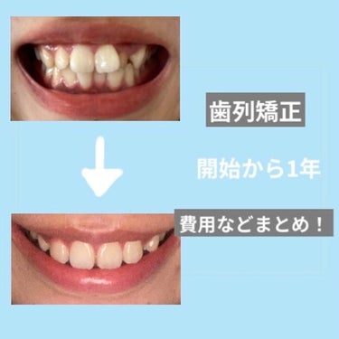 サメ子 on LIPS 「⭐︎歯列矯正開始から一年の経過⭐︎去年の今頃に歯列矯正を始め、..」（1枚目）