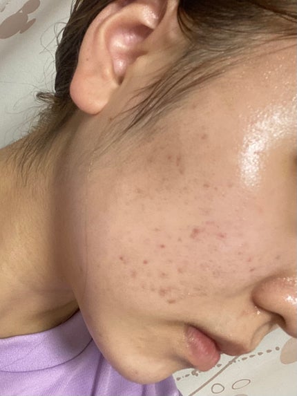 ããð± on LIPS ããã£ãšæ°ã«ãªã£ãŠããã·ã«ã¬ãã賌å
¥ããã®ã§ã2ã¶æã»ã©äœ¿çšãç¶..ãïŒ5æç®ïŒ