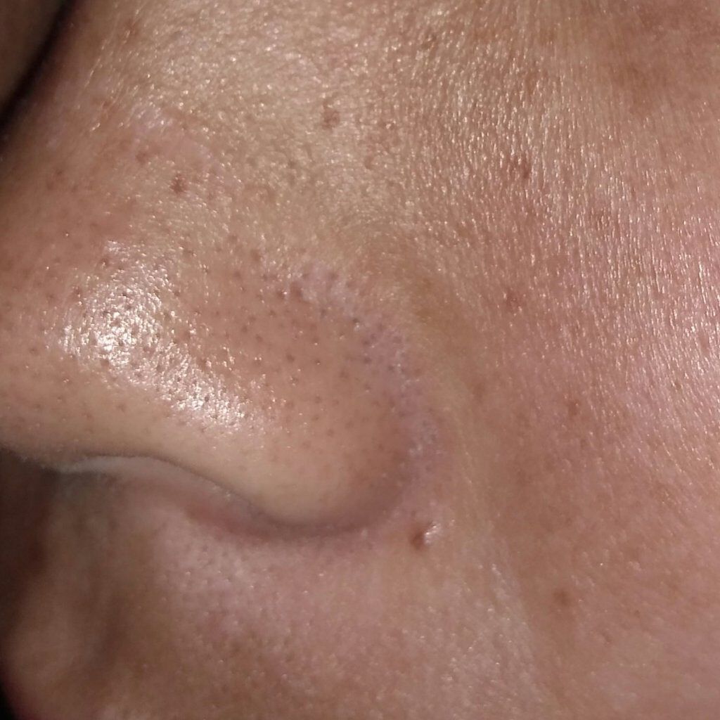 しーまめ。 on LIPS 「写真注意です⚠️皆さん教えて欲しいです!!!!鼻の膨らみの横に..」(1枚目)