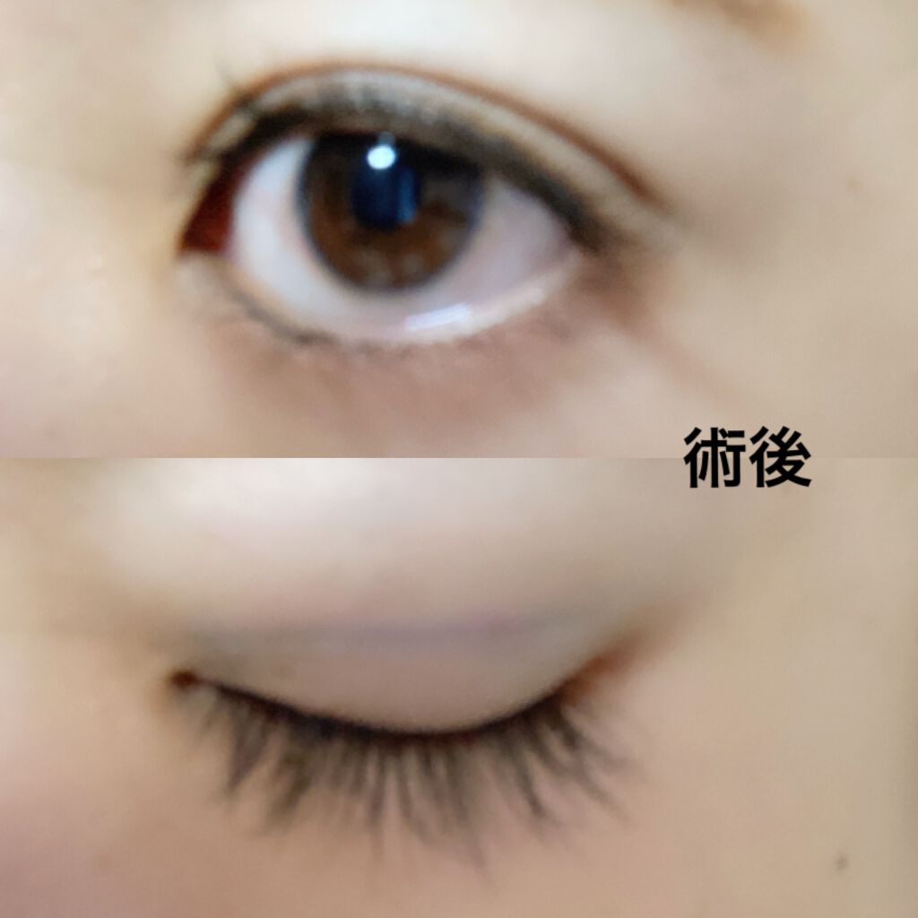 ちび☺︎ on LIPS 「脱☆一重!念願の埋没してきました、、、!二重整形を考えている方..」(2枚目)