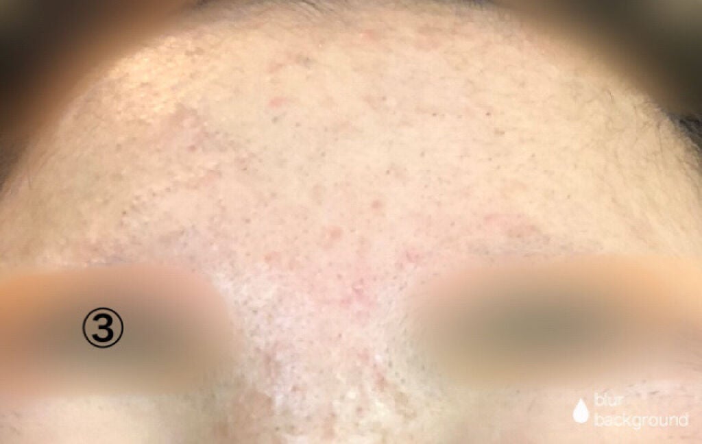 来世はヨンタン🐶 on LIPS 「私は混合肌で皮脂がとても多く、それがニキビの原因でした😭(元々..」(4枚目)