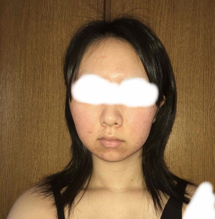 フワフワネコチャン on LIPS 「塗り始めて8日目(9日目朝)の写真です気付いたら1週間経ってた..」(4枚目)