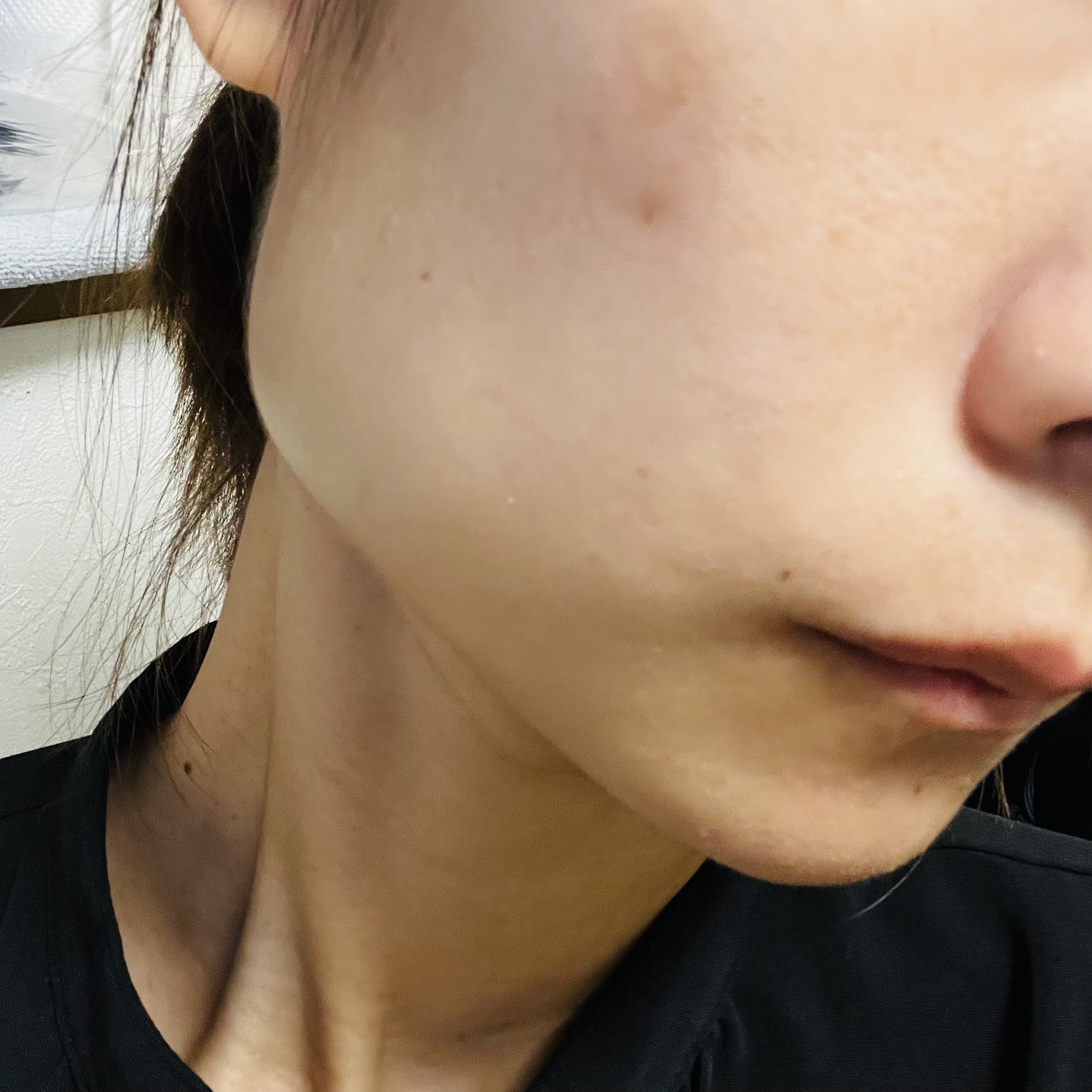 極薄透明パッチ nikipa!/金冠堂/にきびパッチを使ったクチコミ（3枚目）