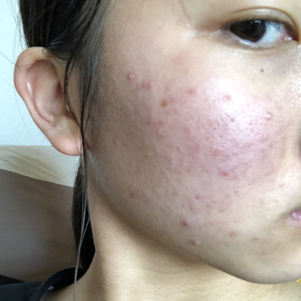 モイスチュア ローション/カルテHD/化粧水を使ったクチコミ（2枚目）