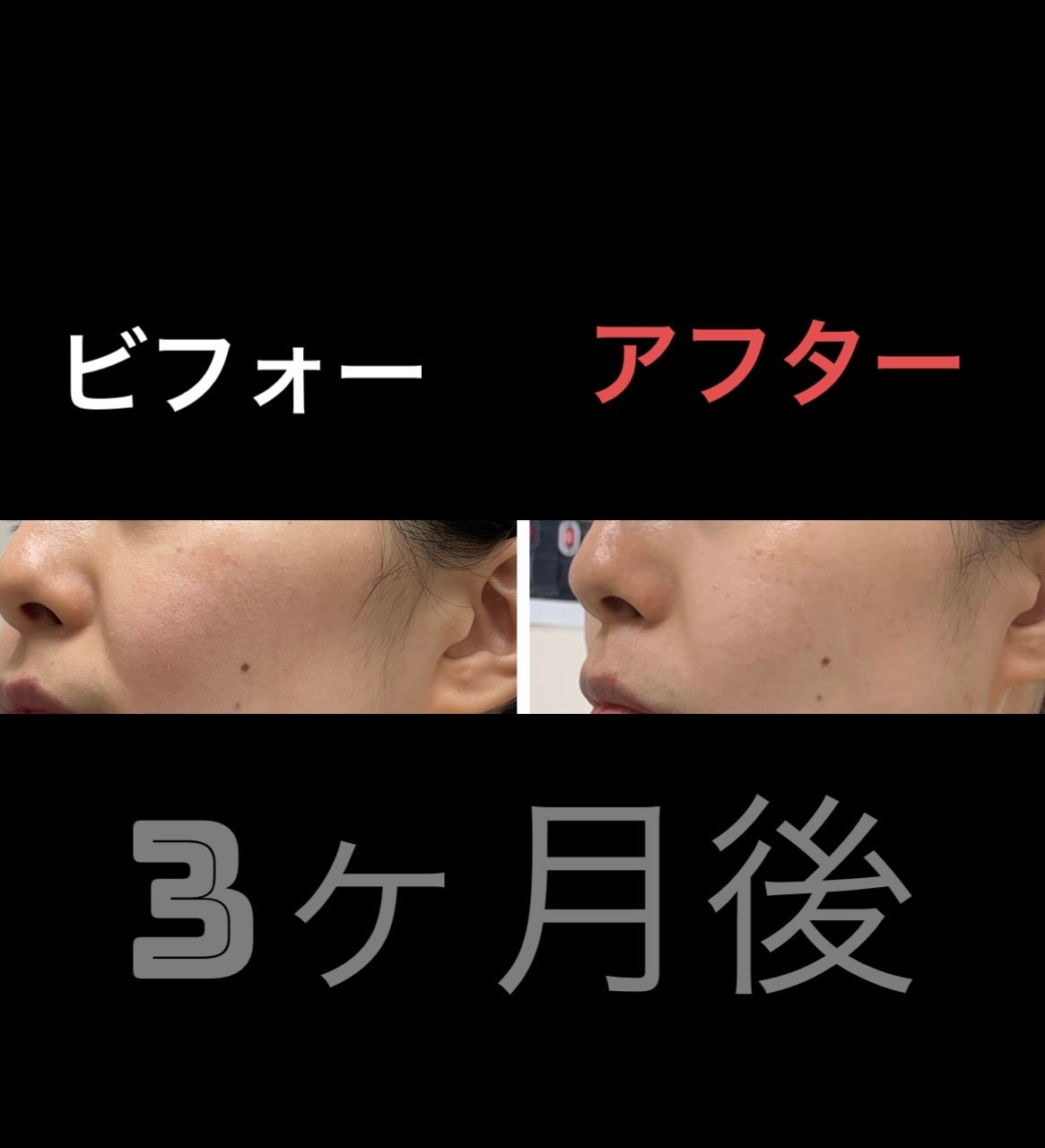 フェイスポインター|CORE FITの口コミ - 【COREFIT】Face フェイスポインター|CORE FITの口コミ - 【COREFIT】Face