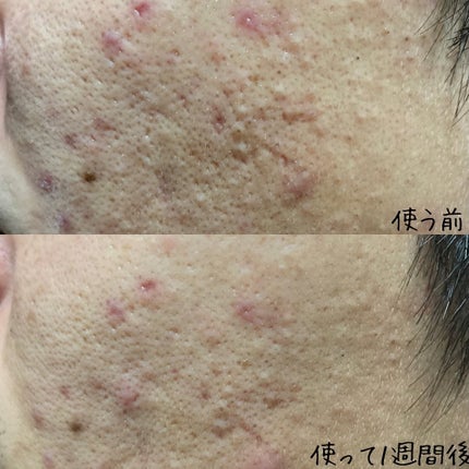 マジックティーツリーオイル/ブラン/フェイスオイルを使ったクチコミ(5枚目)