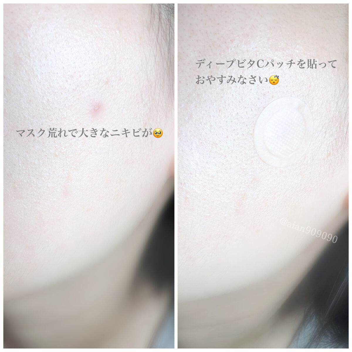 ディープビタCパッチ/MEDICUBE/その他スキンケアを使ったクチコミ(4枚目)