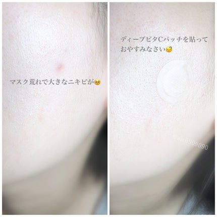 ディープビタCパッチ/MEDICUBE/その他スキンケアを使ったクチコミ(4枚目)