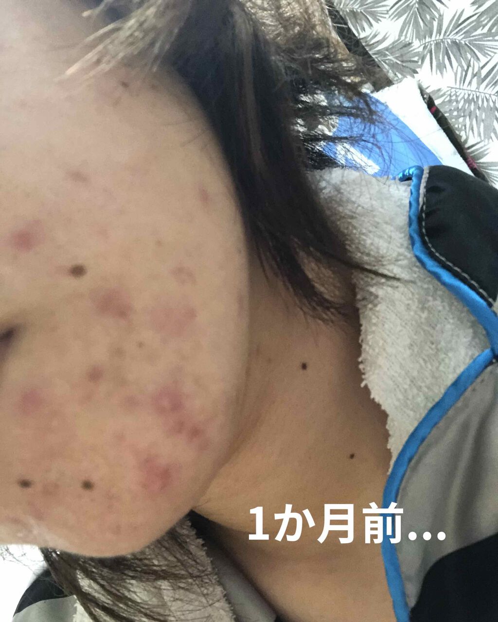 めぐぽん on LIPS 「1ヶ月過ぎましたが...少し消えてるような気がします。もう少し..」(1枚目)