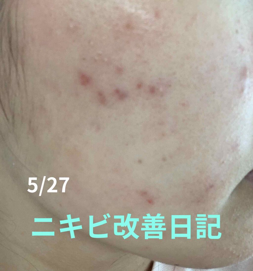 クリンダマイシンゲル(医薬品)/クラシエ薬品/その他を使ったクチコミ（1枚目）