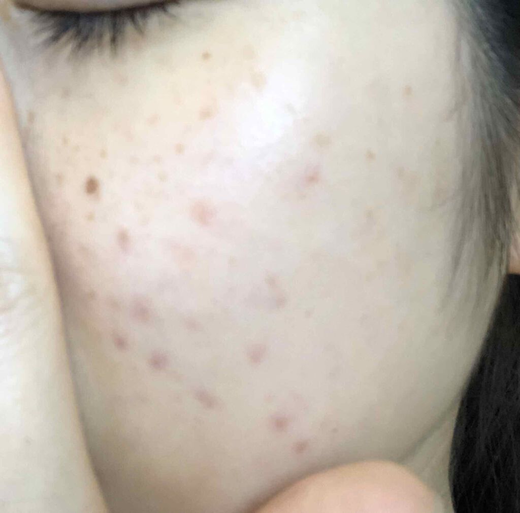 ゆきち on LIPS 「お肌記録1回目の投稿からニキビが増えたり減ったり、、、ですが、..」(1枚目)