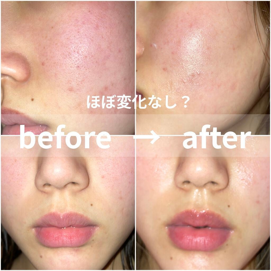 ティーツリーカーミングエッセンスパッド/MEDIHEAL/トナーパッドを使ったクチコミ(1枚目)