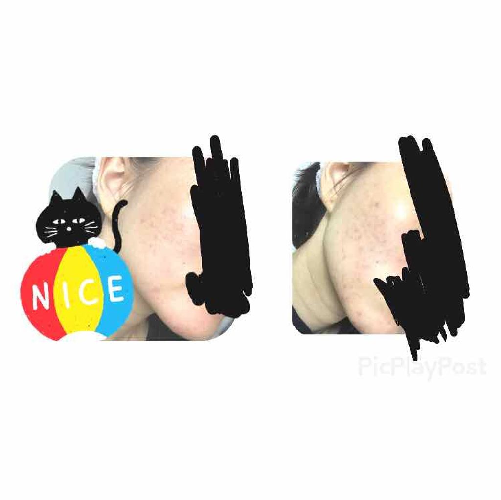 さいきa 保水治療ローション(医薬品)/Saiki/その他を使ったクチコミ(2枚目)