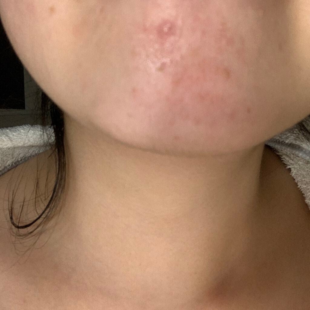 ノブ A アクネソープ/NOV/洗顔石鹸を使ったクチコミ(2枚目)