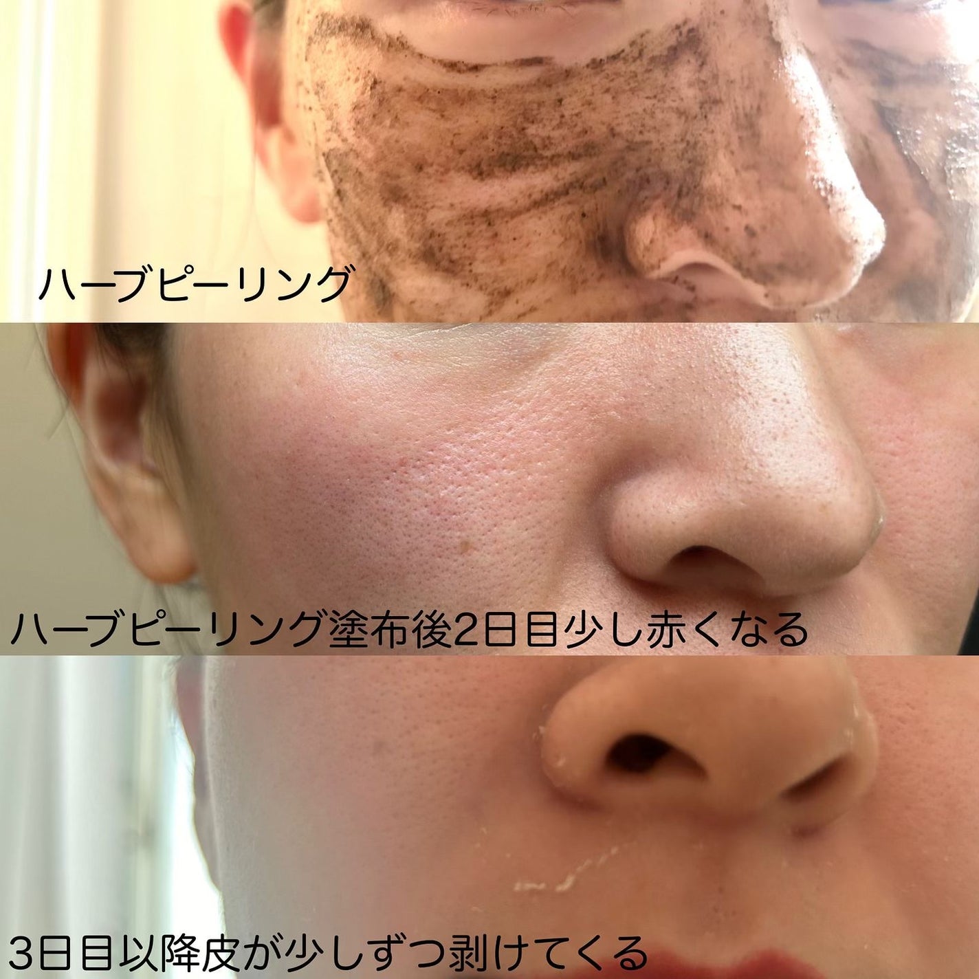 ダーマスキンピーリング/BQCELL/その他キットセットを使ったクチコミ(3枚目)