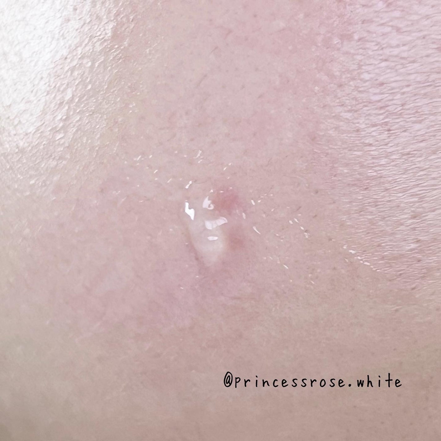 ミラクルクリアスージングスポットジェル/Rael/にきびパッチを使ったクチコミ(9枚目)